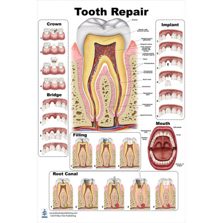 Tooth Repair Large Poster, Tooth Decay