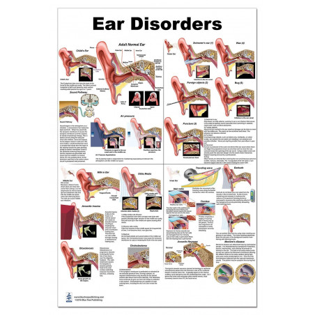 Ear Disorders Large Poster