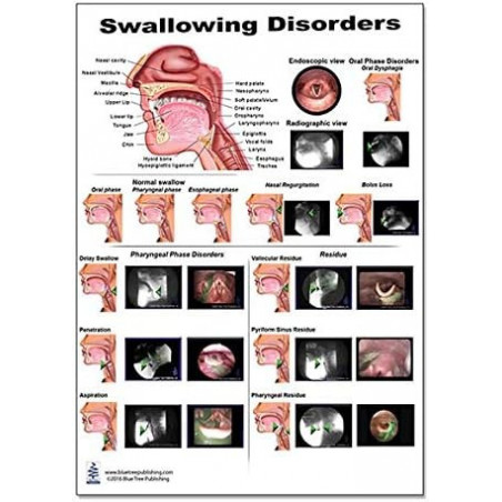 Swallowing Disorders Regular Poster