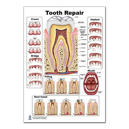 Tooth Repair Regular Poster, Tooth Decay