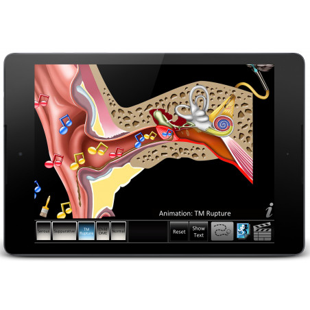 Otitis Media Disorders App