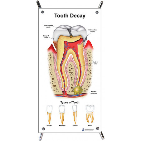 Tooth Decay Small Poster
