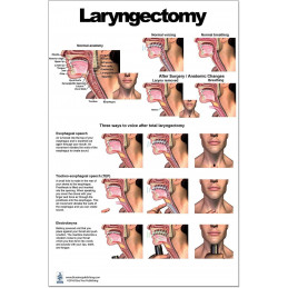 Laryngectomy