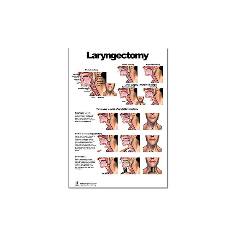Laryngectomy Regular Poster