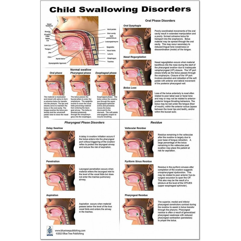 Child Swallowing Disorders Chart, 12x17inch, Dysphagia Endoscopic View-oral Phase Disorders-nasal Regurgitation