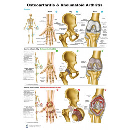 Osteoarthritis & Rheumatoid Arthritis, Large Poster 24x36
